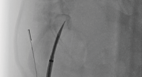 Atrial septal puncture