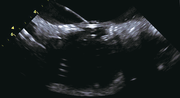 Atrial septal puncture