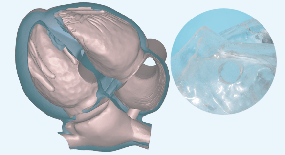 Atrial septal defect