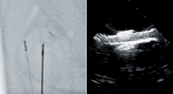 Confirmation of placement position by X-ray fluoroscopy
