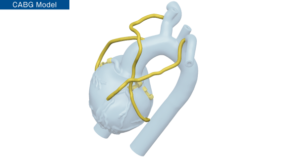 CABG Model