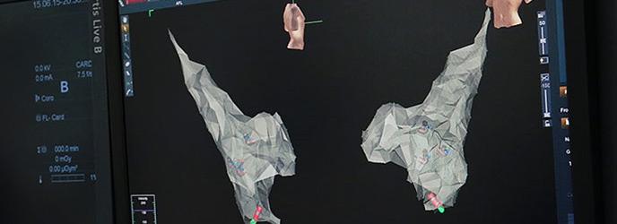 Ablation Model