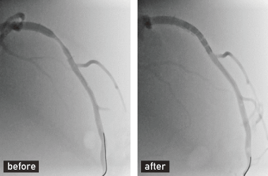 Stenting