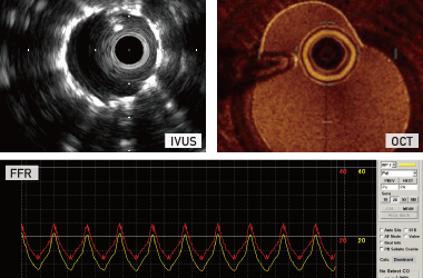 IVUS