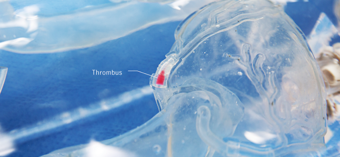 Thrombus