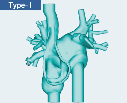2-chamber design RA and LA with SVC, IVC