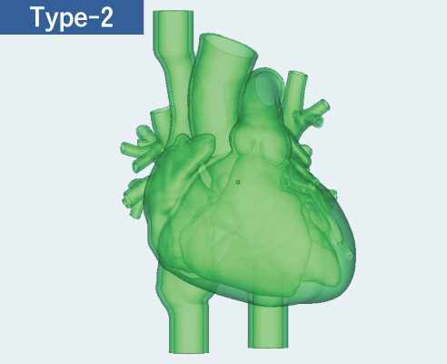 4-chamber design RA, LA, RV, LV with SVC, IVC and CS