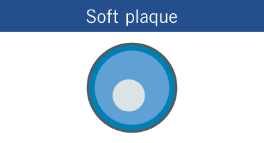 Soft plaque